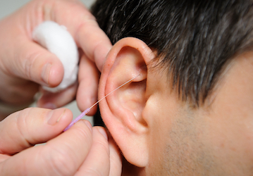 Acupuncture needle being inserted in patient s ear as a holistic means to improve wellness and stress 