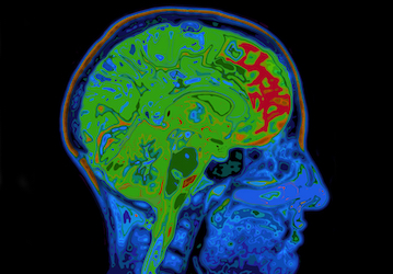 Digital image of brain shows mostly green areas with red spots in front where a concussion happened after a training injury