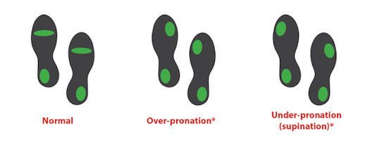 Normal pattern shows the most wear towards the ball of the foot behind the second toe. Over-pronation shows more wear towards the inside edge of the ball of the foot. Under-pronation (supination) have the most wear towards the outside edge.